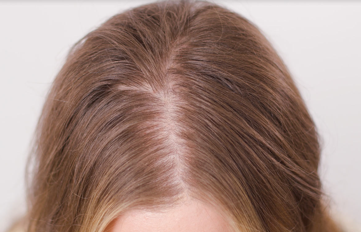 alopecia