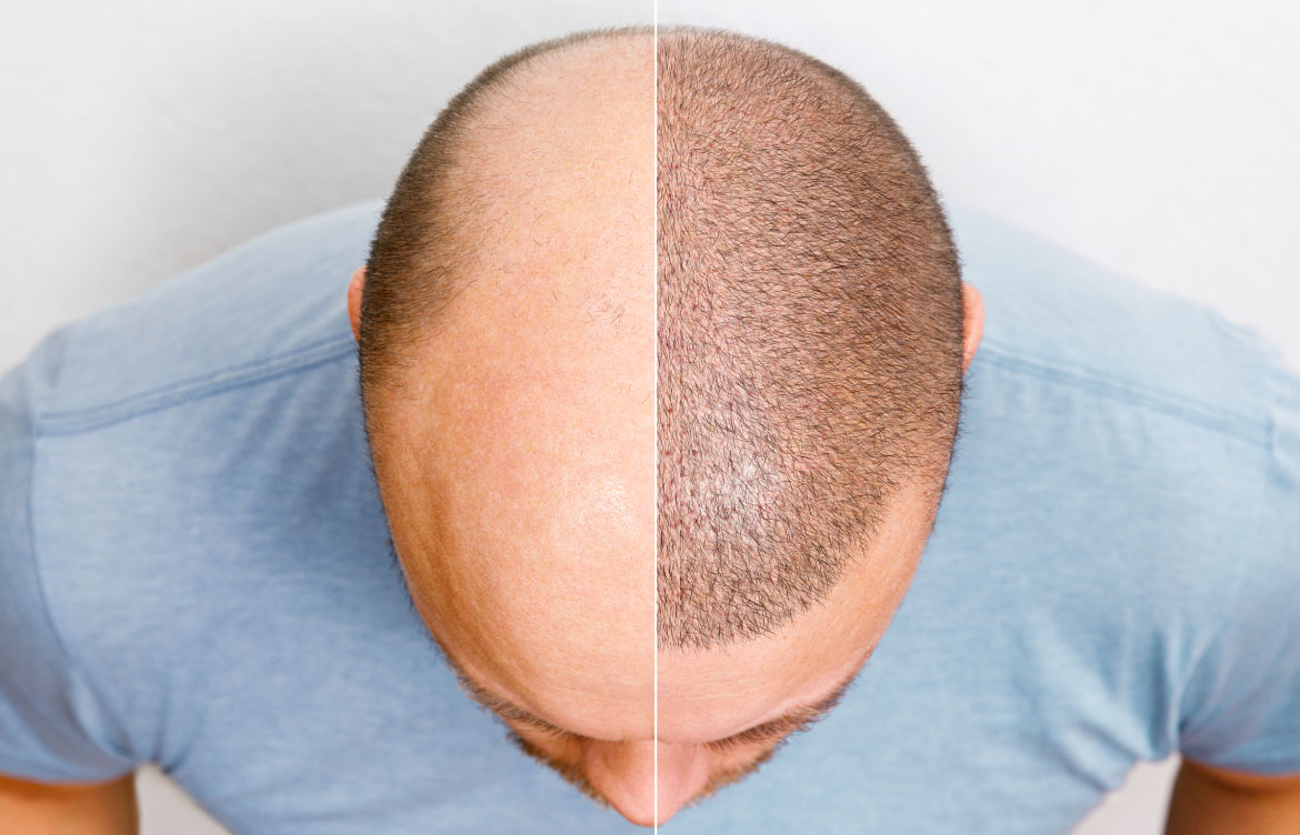 hair-transplant